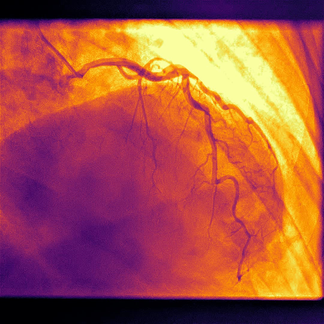 die>com — a coronary angiogram rendered as glowing vessels, from the Doppelganger performance